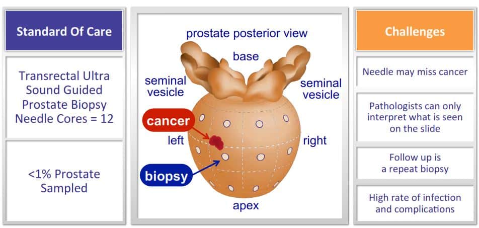 Typical_Prostate_Cancer_Biopsy