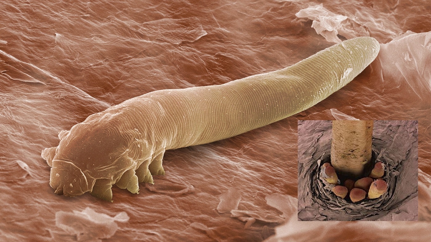 The harmless mite Demodex folliculorum, seen here in an electron microscope image, lives in the follicles of eyelashes
