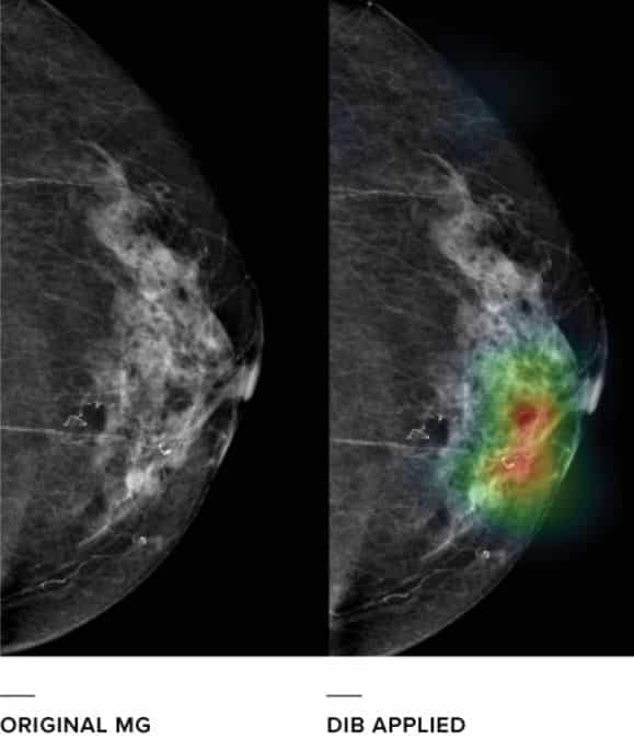 Lunit's medical image results of breast cancer