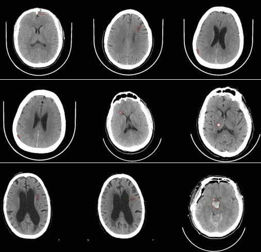 Medical Images of Stroke from Viz