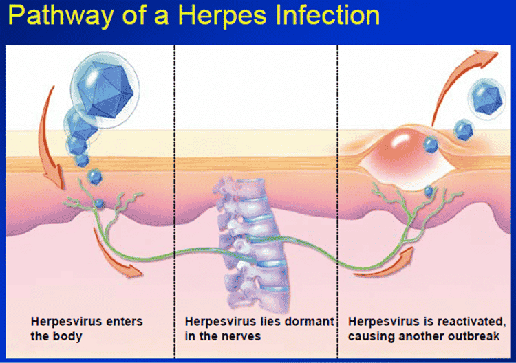 Pathway of a Herpes Infection