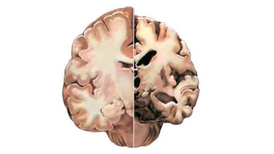 Your brain on Alzheimer's. 