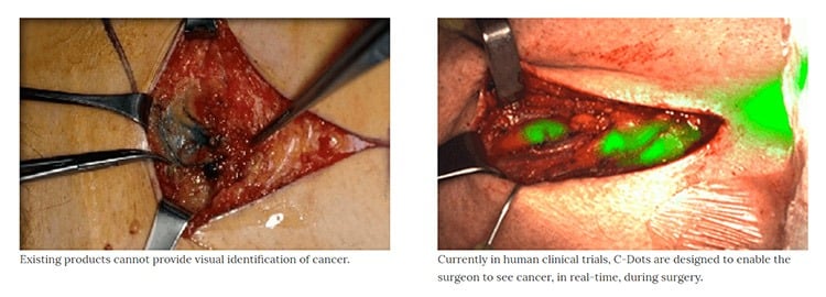 Cancer surgery using nanoparticle dye.