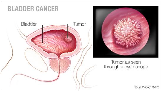 Bladder cancer
