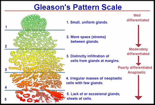 Gleason's Pattern Scale