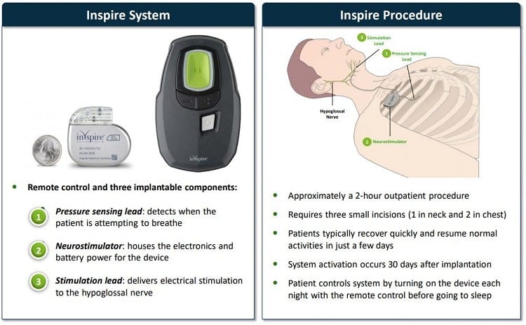 Inspire system and procedure