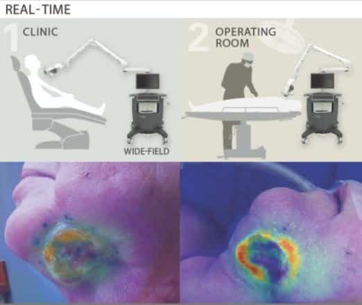 Real-time cancer detection