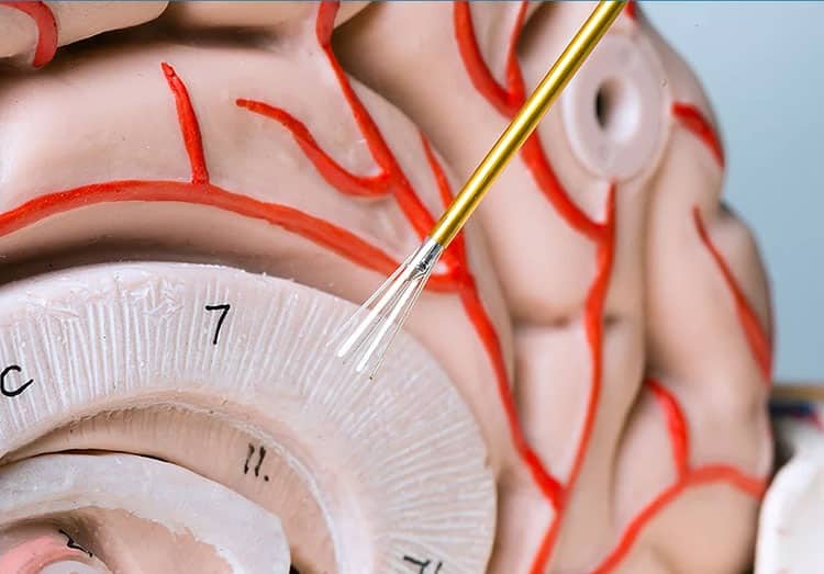 Deep brain stimulation example.
