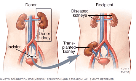 A kidney transplant