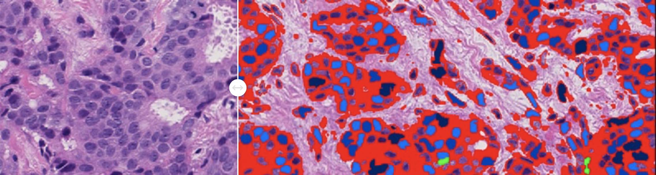Virasoft highlights and detects tumoral cell regions automatically