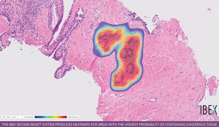 Heat map of cancerous tissue. 