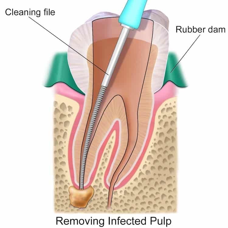 A root canal procedure involves removing the insides of the tooth and plugging the open canal in with a special filler
