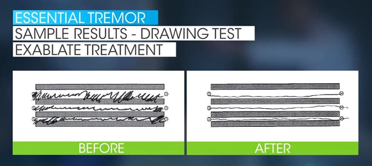 Results of an ultrasound treatment on someone with tremors.