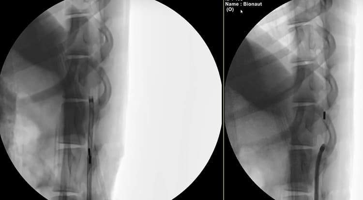 X-ray images of the spine with Bionaut robot.