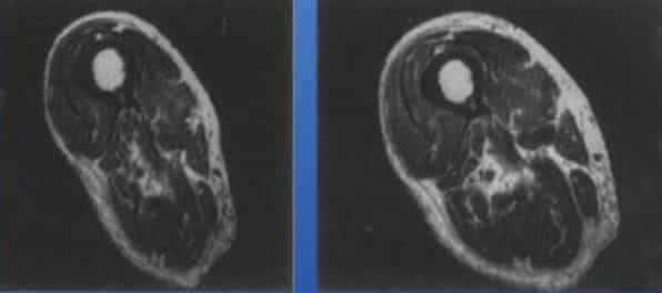 image shows us the mid-thigh region of a male subject, 92 years of age, after just 12 weeks of resistance training. Credit: Dr. Doug McGuff